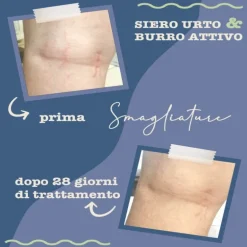 Trattamento smagliature